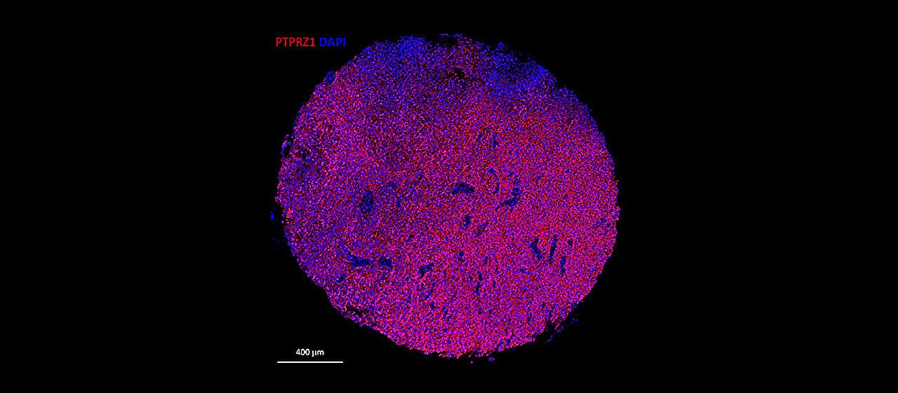 CAR-T Cells Target Glioblastoma, Sparing Healthy Tissue